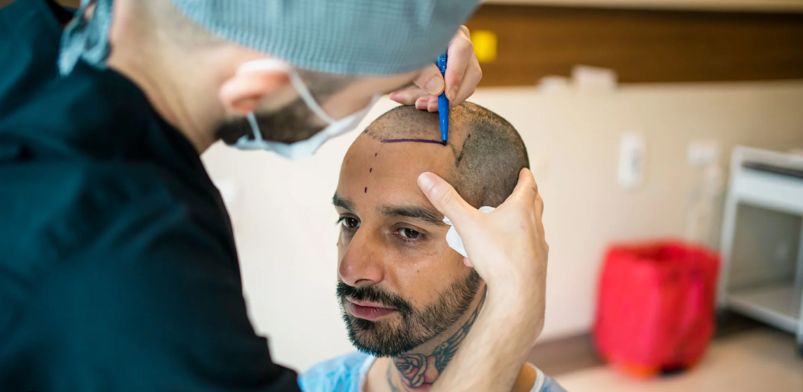 How to Choose the Best Hair Transplant Method